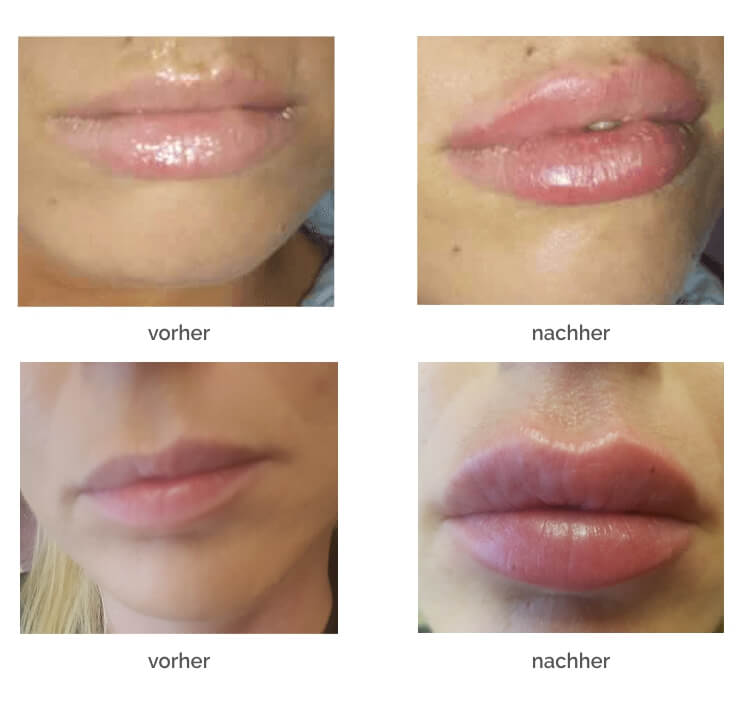 Hyaluronsaure Lippen Wunderschone Lippen Expertin